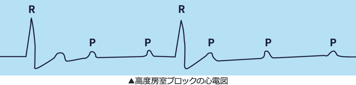 高度房室ブロックの心電図