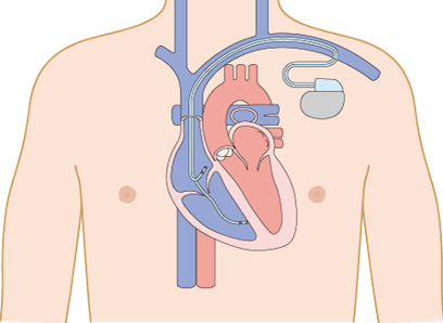 恒久的ペースメーカ埋め込み術
