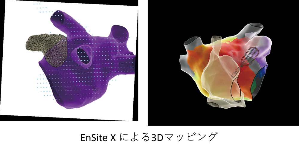 EnSite X による3Dマッピング