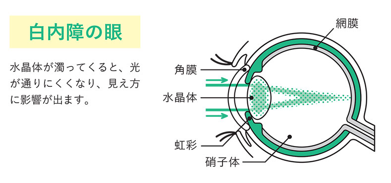 白内障の眼