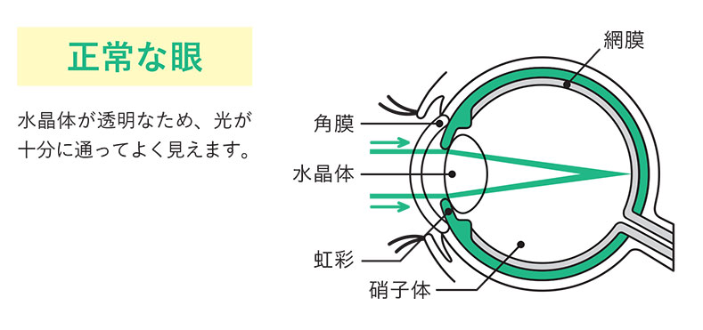 正常な眼