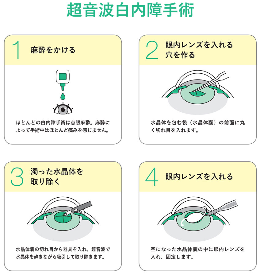 超音波白内障手術